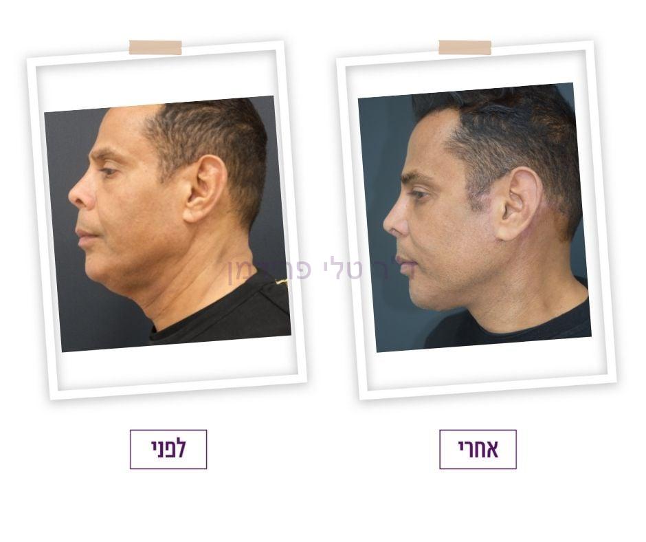 מתיחת פנים לגברים